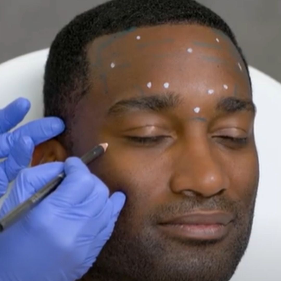 Facial marking for cosmetic procedure preparation.