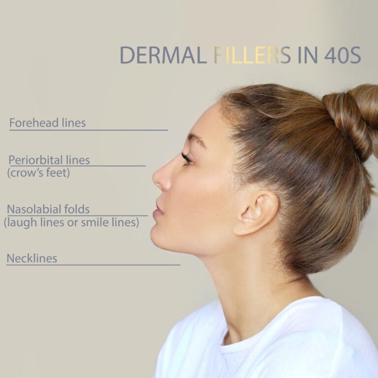 Dermal fillers for facial line treatment in 40s