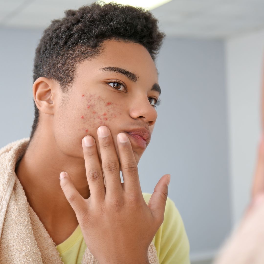 Teen inspecting acne on his face.