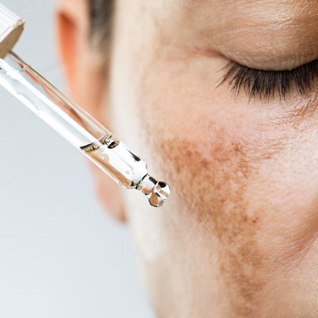 Close-up of face with dropper applying serum.