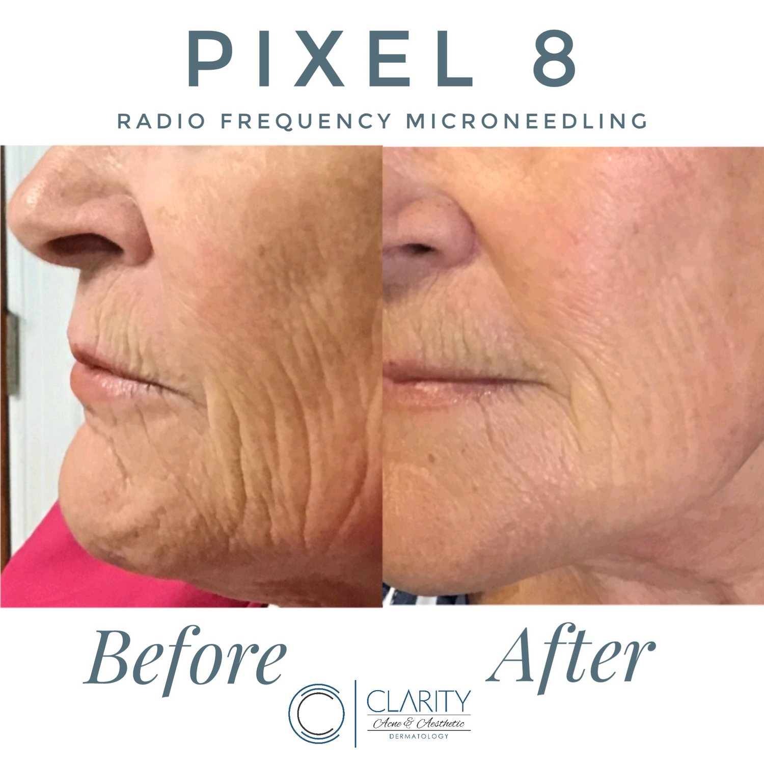 Before and after radio frequency microneedling treatment.