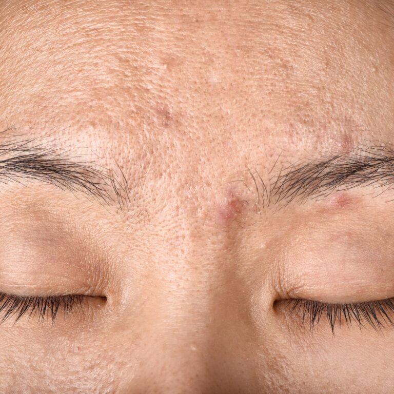 Close-up of skin with acne and blemishes.