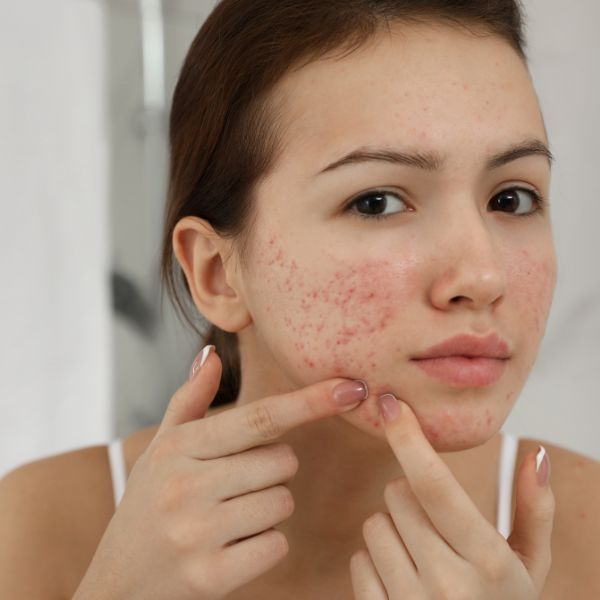 Young woman examining her acne-prone skin.