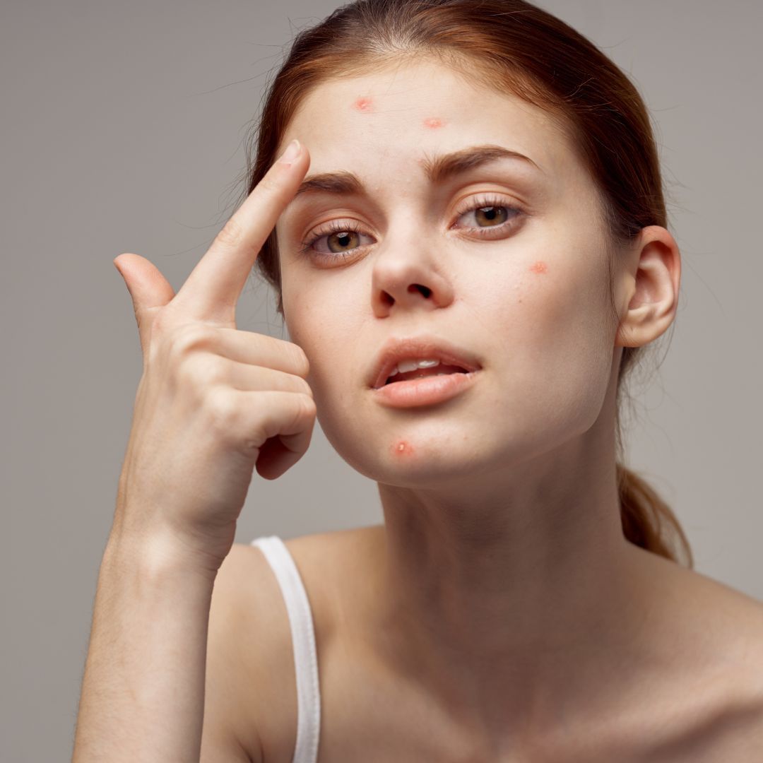 Woman showing acne on her face.