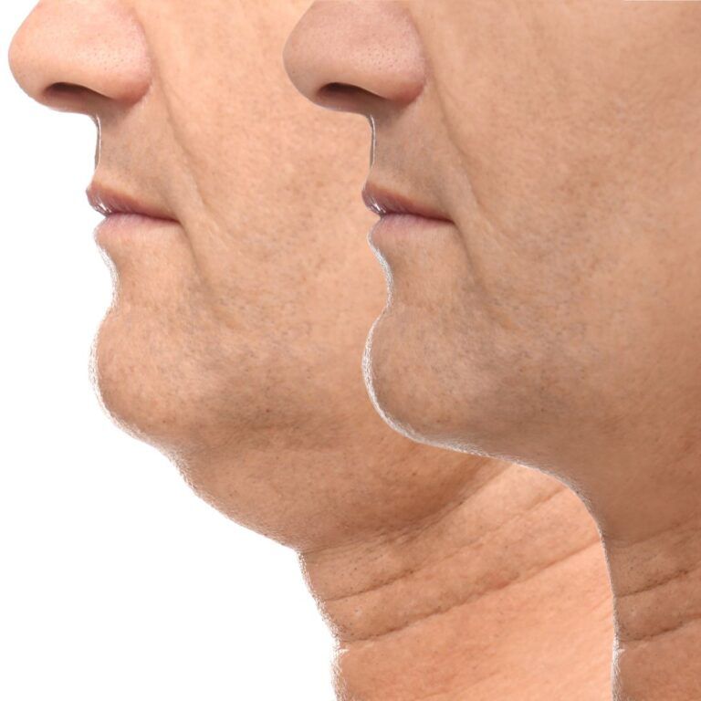 Before and after facial profile comparison.