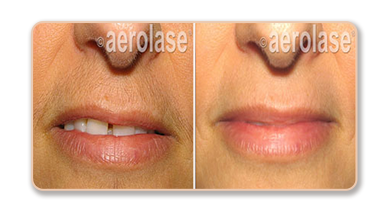 Before and after lip treatment comparison photos.