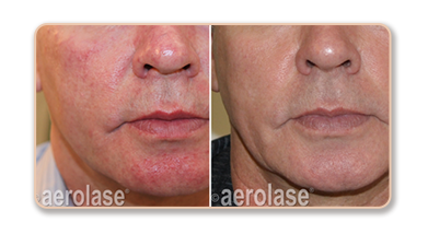 Before and after skin treatment comparison.