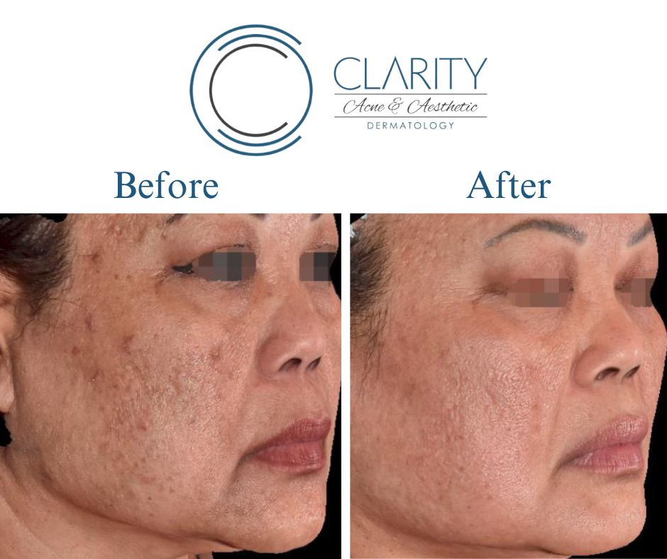 Microneedling Before & After