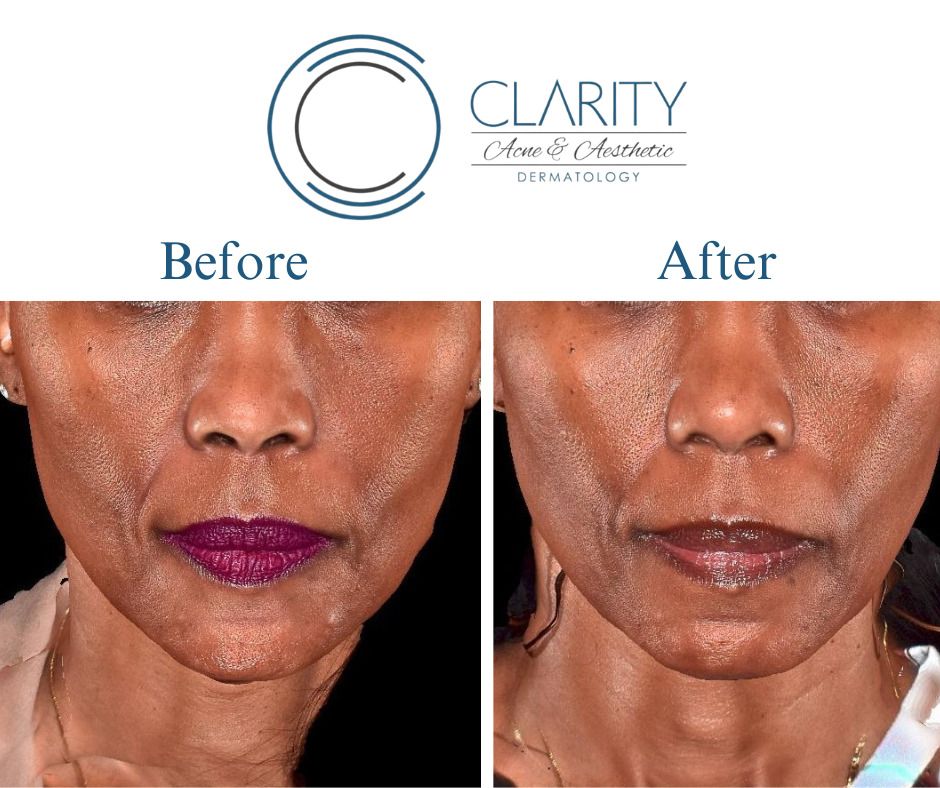 Dermal Filler Before & After