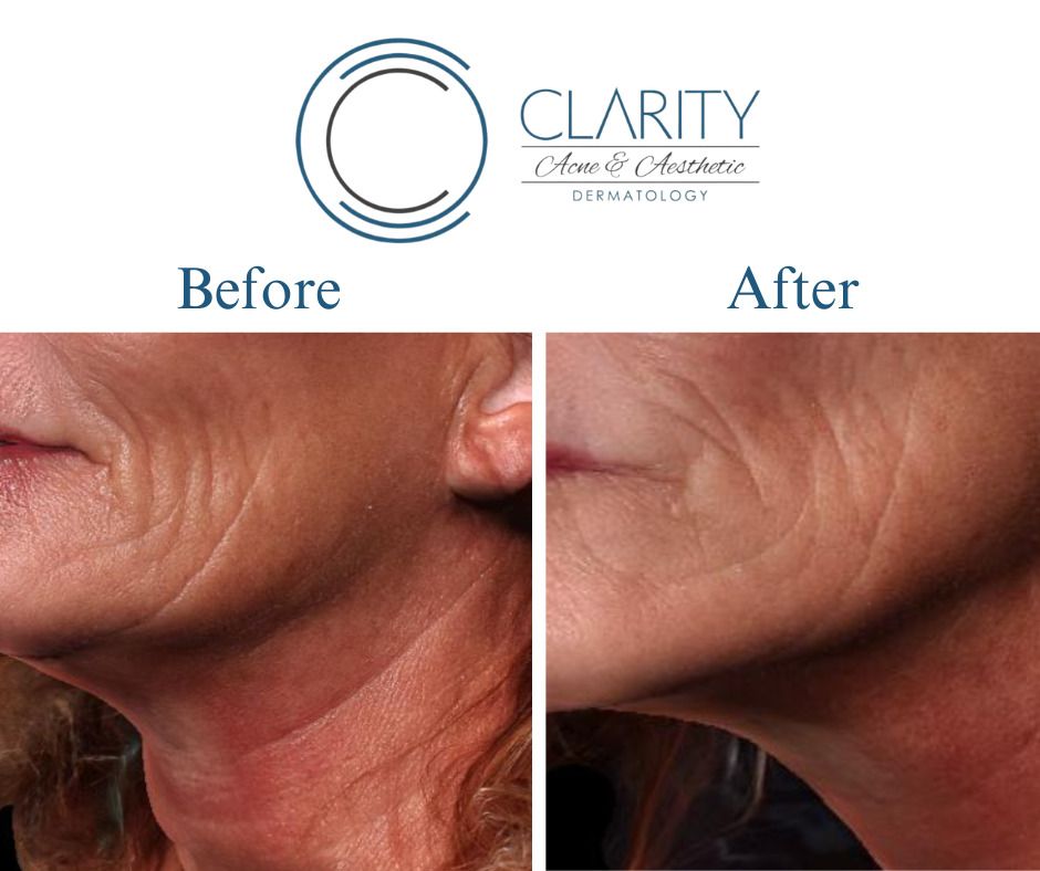 Dermal Filler Before & After