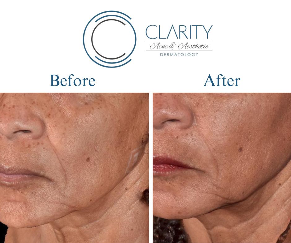 Dermal Filler Before & After