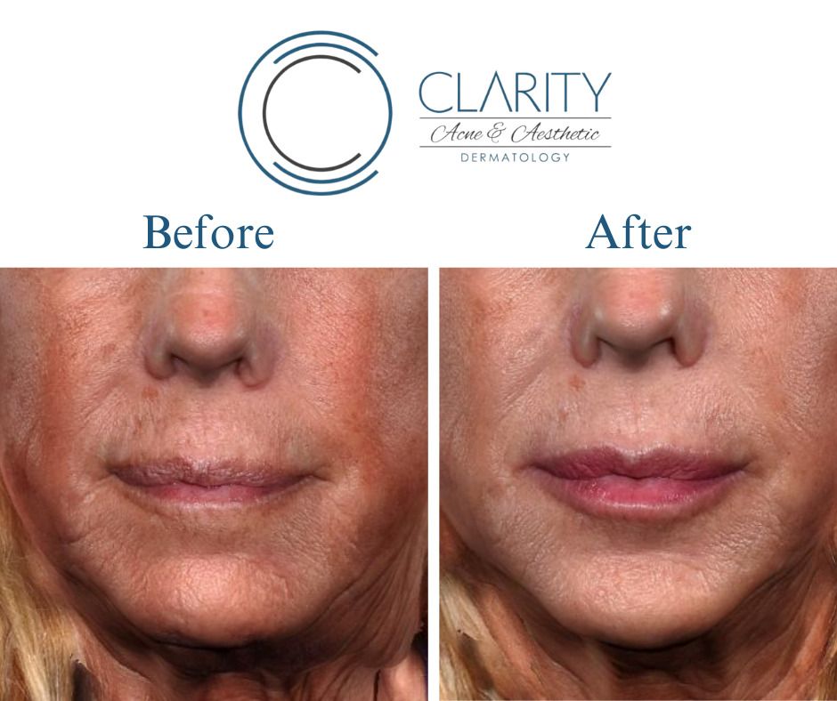 Dermal Filler Before & After