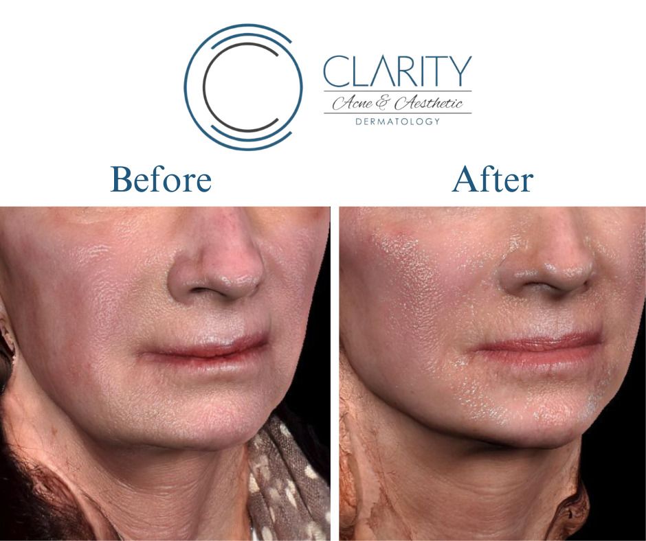 Dermal Filler Before & After