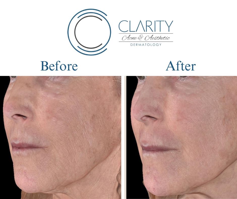 Erbium Before & After