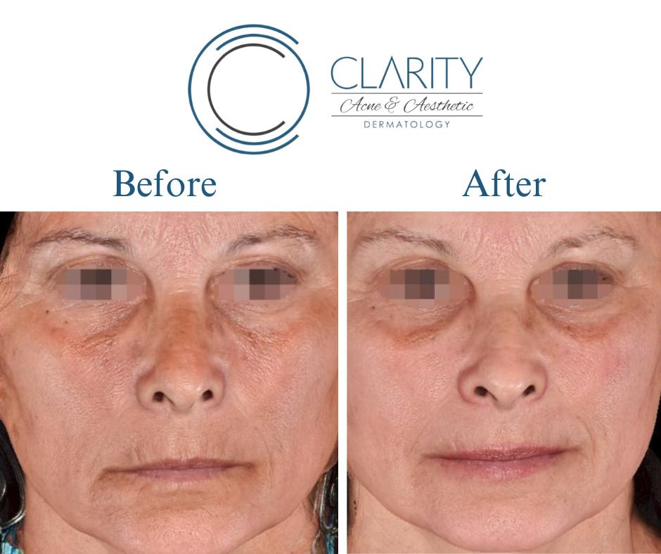 Pixel 8 Before & After