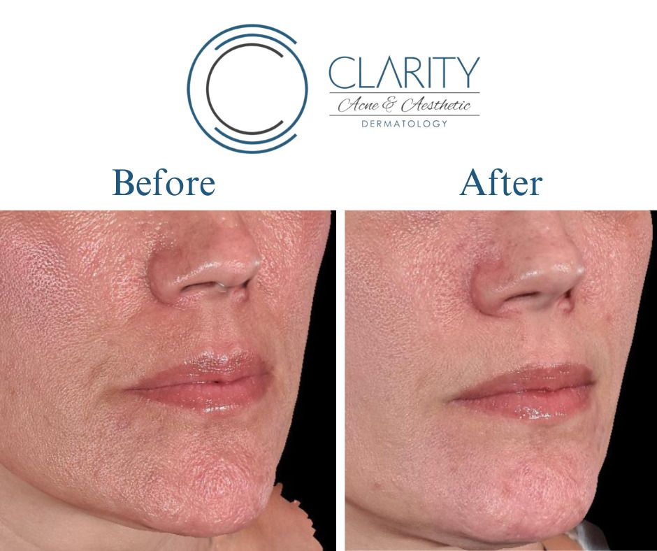 Pixel 8 Before & After