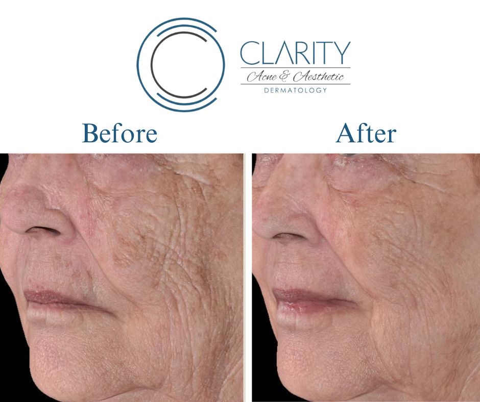 Pixel 8 Before & After