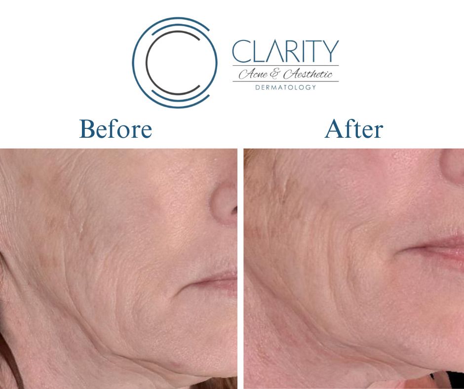 Pdo Threads Before & After