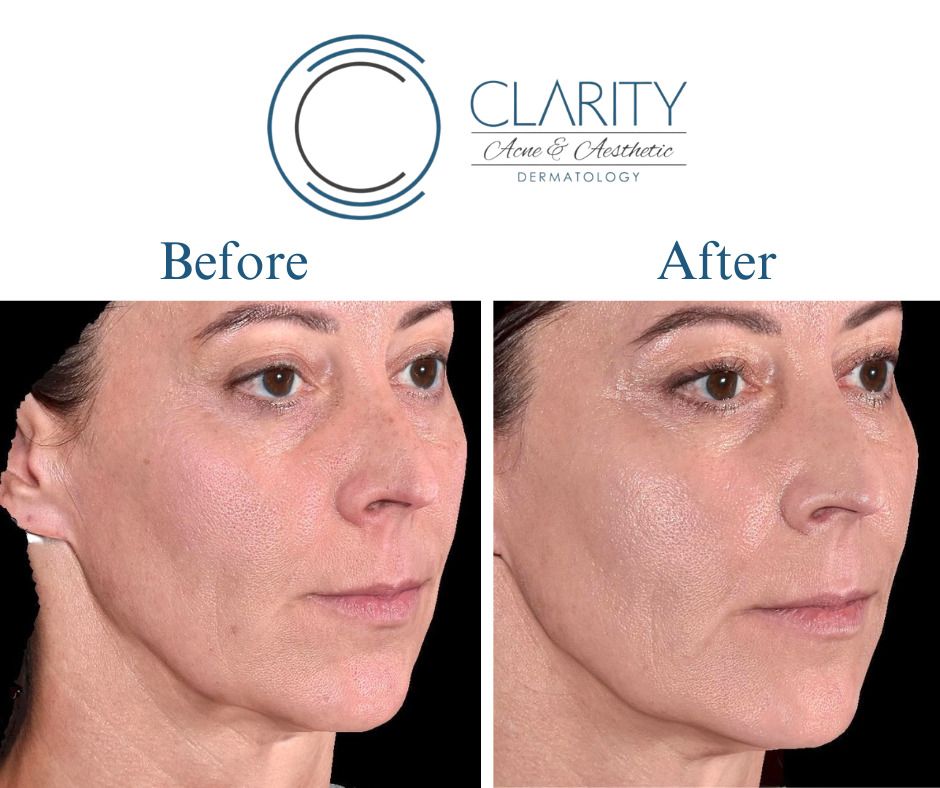 Pdo Threads Before & After