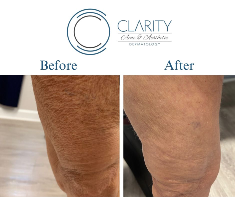 Pdo Threads Before & After