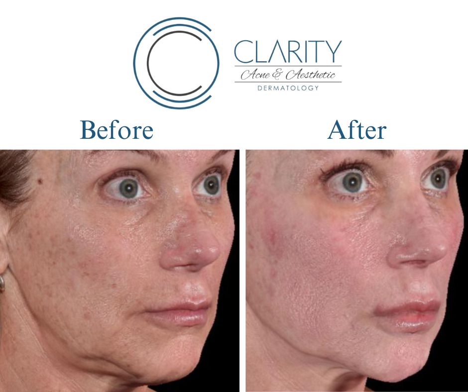 Pdo Threads Before & After