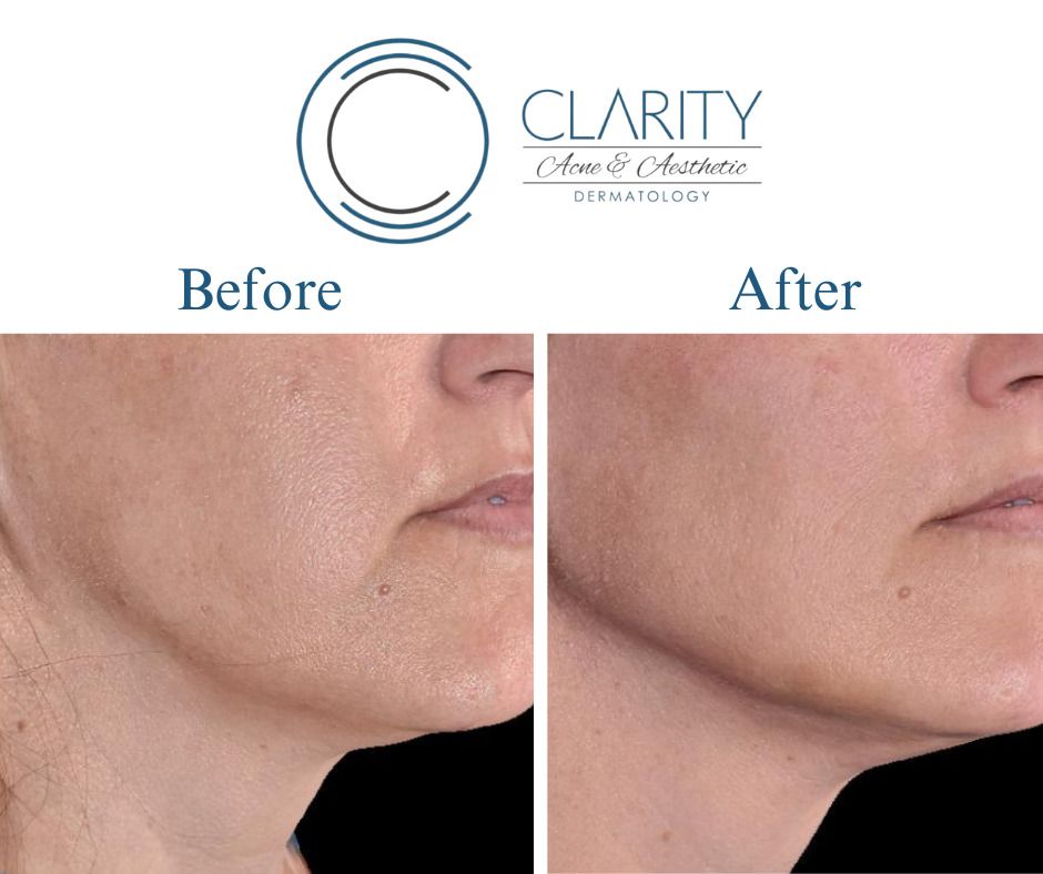 Jawline Filler Before & After