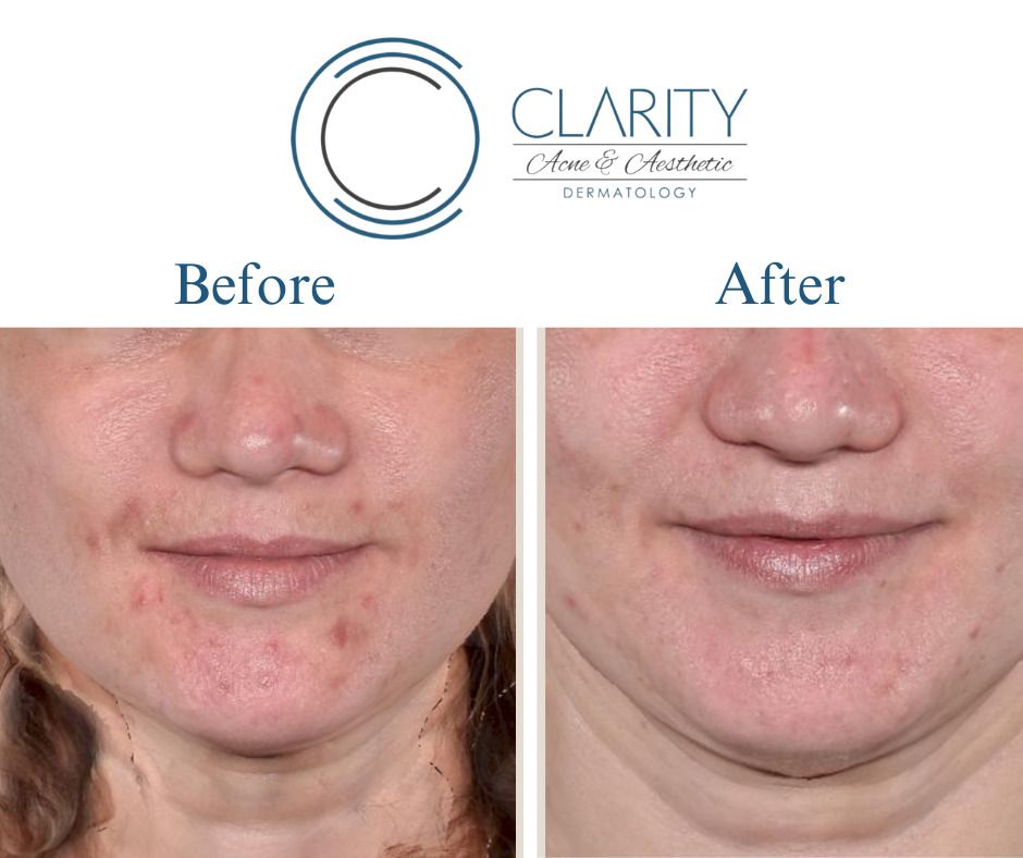 Aerolase Before & After