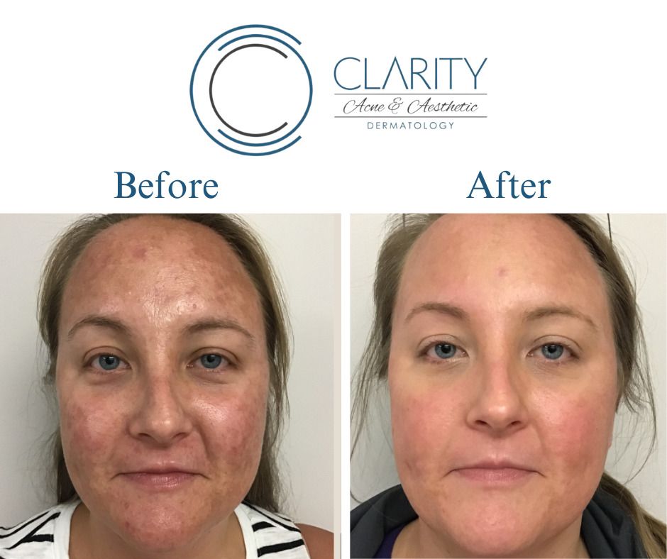 Aerolase Before & After