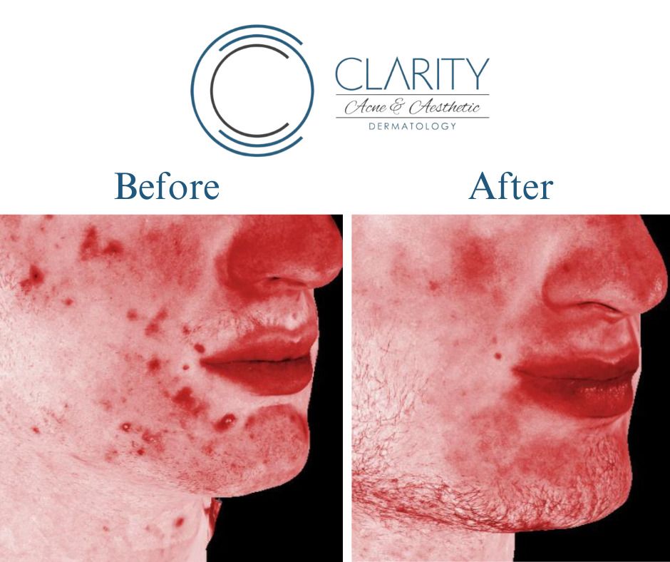 Aerolase Before & After