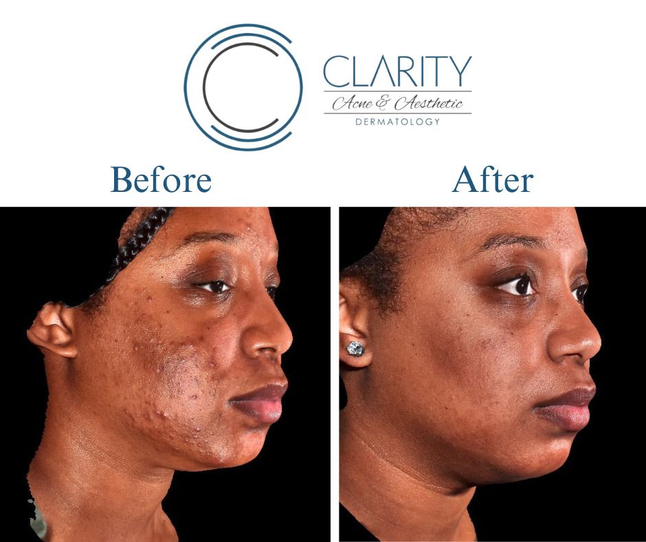 Aerolase Before & After