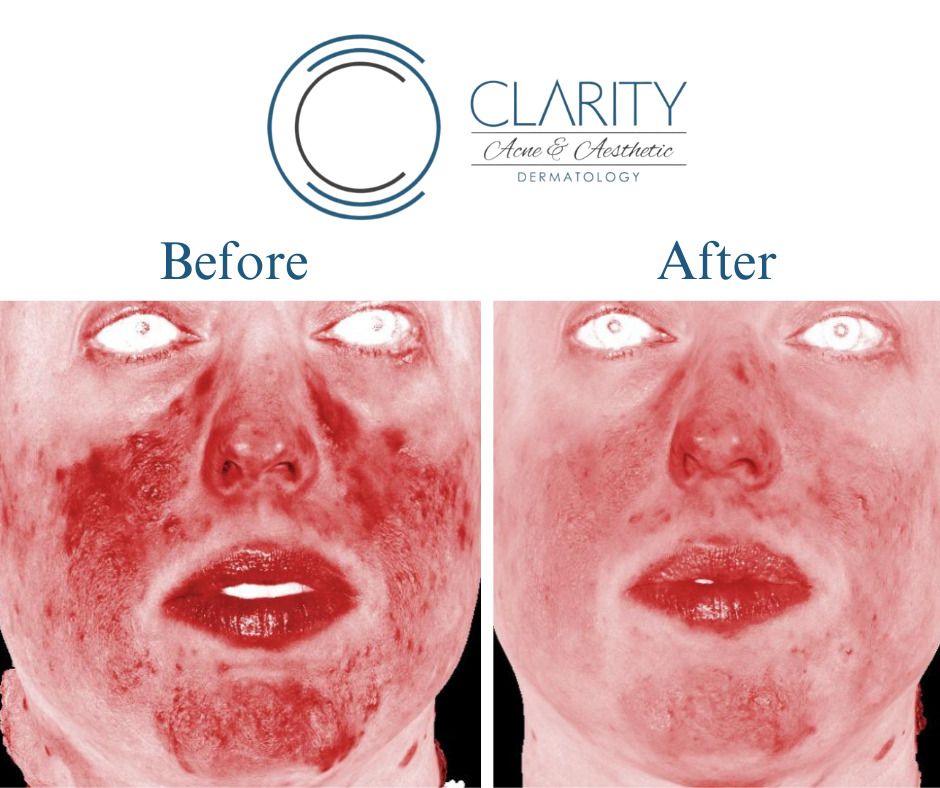 Aerolase Before & After