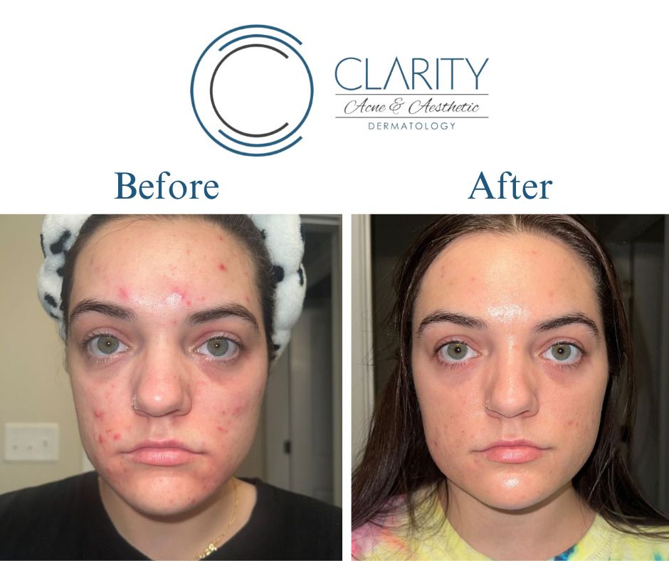 Aerolase Before & After