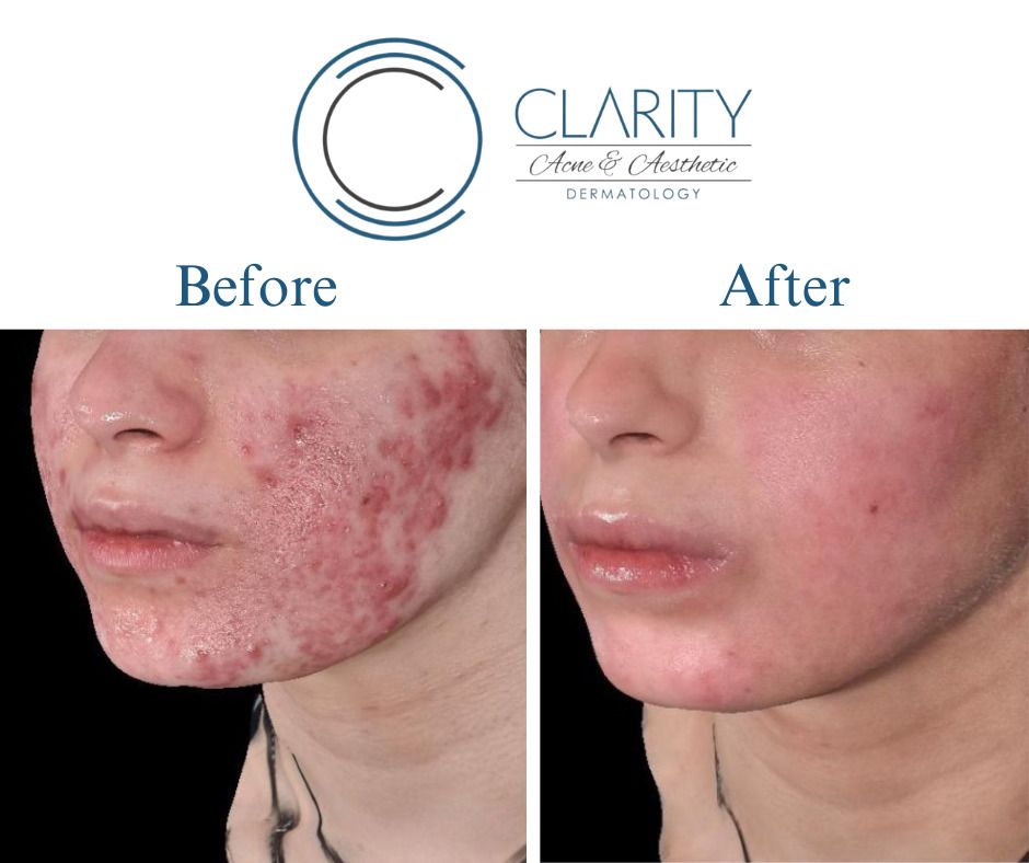 Isotretinoin With Aerolase Before & After