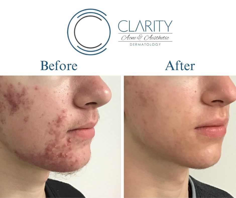 Isotretinoin With Aerolase Before & After