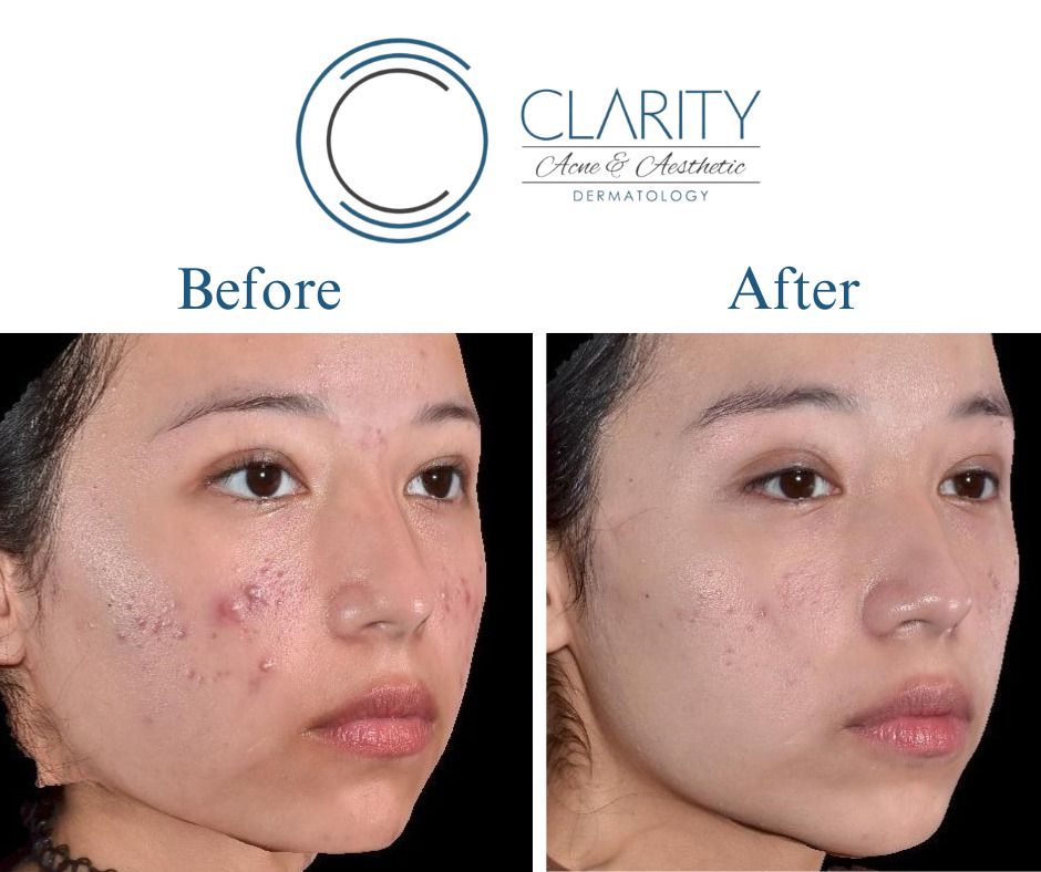 Vi Peel Before & After