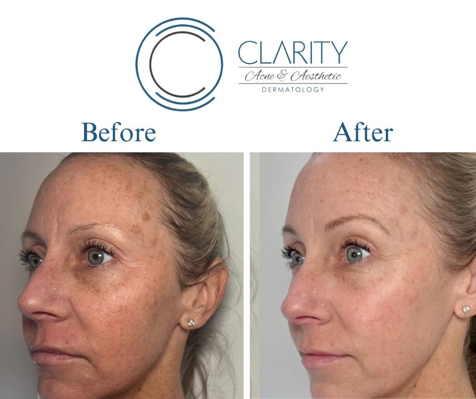 Clear And Brilliant Before & After