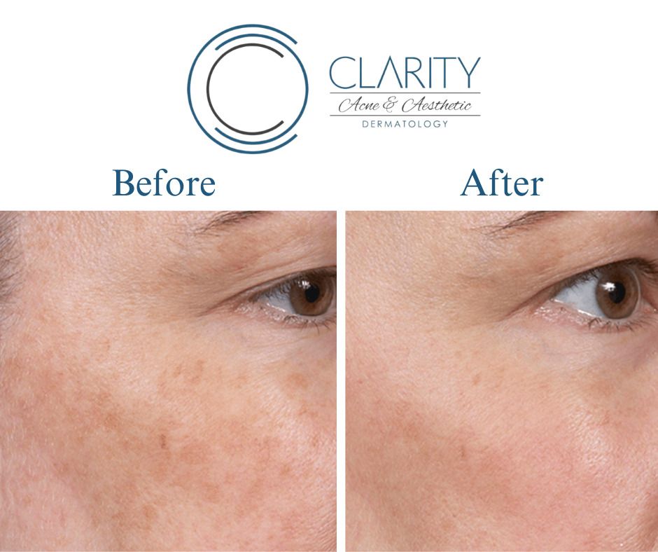 Clear And Brilliant Before & After