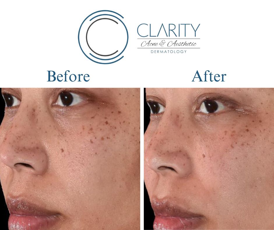 Under Eye Filler Before & After